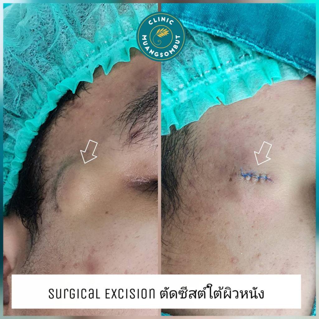 ตัดเนื้องอกหาดใหญ่