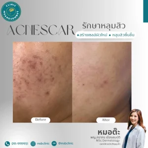 Subcision Acne Scar Program_ A treatment technique for acne pits and scars caused by underlying fibrous bands.